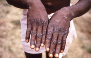 Edo State intensifies coordinated response to contain spread of Monkeypox disease