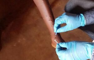 UNICEF issues $58.8 million appeal to halt Mpox spread in Africa