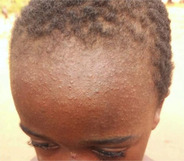 A little boy suffering from Measles-WHO