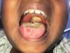 FG activates emergency task force as Diphtheria outbreak hit Katsina, Kano States