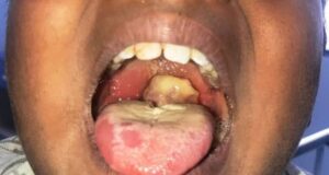 FG activates emergency task force as Diphtheria outbreak hit Katsina, Kano States