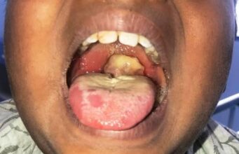 FG activates emergency task force as Diphtheria outbreak hit Katsina, Kano States