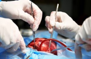 FG sets new organ transplant guideline to curb exploitation and protect the vulnerable