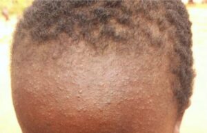 Measles deaths down 88% since 2000, but cases surge-WHO new report